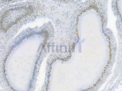 Nucleophosmin Antibody - AF7703 at 1/100 staining human testicular cancer by IHC-P.