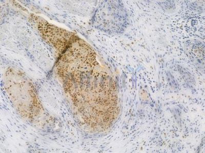 PKM2 Antibody - AF7729 at 1/100 staining human esophageal carcinoma by IHC-P.