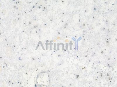 MAPKAPK2 Antibody - AF7809 at 1/100 staining human astrocytoma by IHC-P.