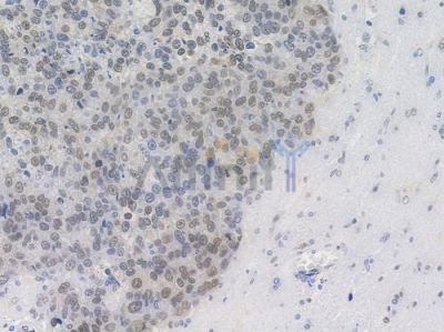 MAPKAPK2 Antibody - AF7809 at 1/100 staining human glioblastoma by IHC-P.