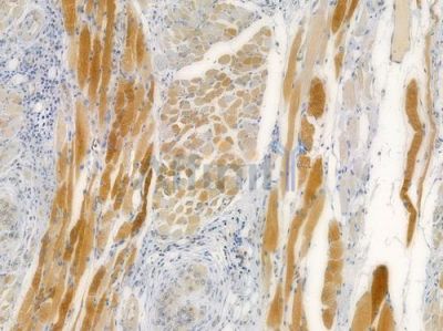 ATP citrate lyase Antibody - AF7823 at 1/100 staining human tongue carcinoma by IHC-P.