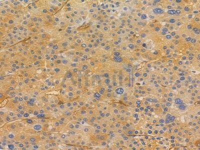 p130 Cas Antibody - AF7827 at 1/100 staining human hepatocellular carcinoma by IHC-P.