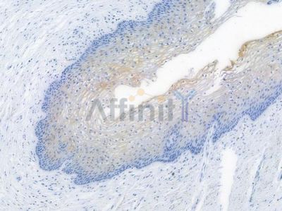 Phospho-AKT1/2/3 (Ser473) Recombinant Rabbit mAb - BF3004 at 1/100 staining human cervical carcinoma by IHC-P.