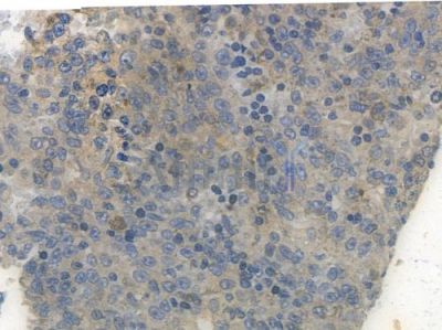 AMPK alpha 1 Recombinant Rabbit mAb - BF3012 at 1/100 staining human melanoma by IHC-P.