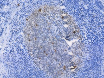 Ki67 Recombinant Rabbit mAb - BF3018 at 1/100 staining tonsil carcinoma sections by IHC-P.