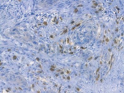 IKB alpha Recombinant Rabbit mAb - BF3027 at 1/100 staining human tongue carcinoma by IHC-P.