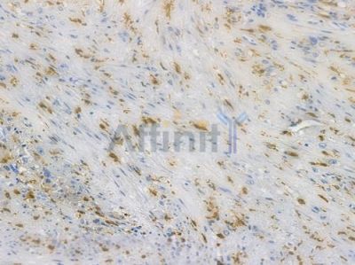HO-1 Recombinant Rabbit mAb - BF3045 at 1/100 staining human prostate carcinoma by IHC-P.