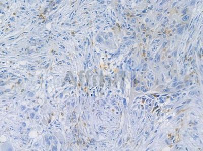 CD68 Recombinant Rabbit mAb - BF3060 at 1/100 staining human tongue carcinoma by IHC-P.