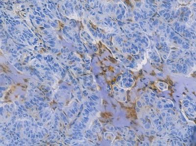 CD68 Recombinant Rabbit mAb - BF3060 at 1/100 staining human lung adenocarcinoma by IHC-P.