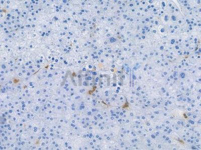 CD68 Recombinant Rabbit mAb - BF3060 at 1/100 staining human hepatocellular carcinoma by IHC-P.