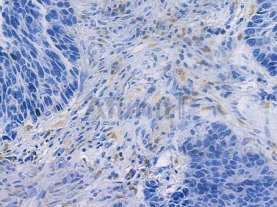 CD68 Recombinant Rabbit mAb - BF3060 at 1/100 staining human large cell lung carcinoma by IHC-P.