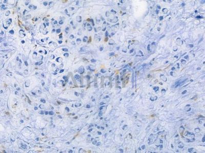 CD68 Recombinant Rabbit mAb - BF3060 at 1/100 staining human gastric carcinoma by IHC-P.
