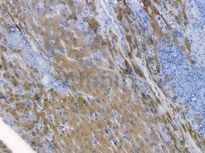 Cox2 Recombinant Rabbit mAb - BF3061 at 1/100 staining human pancreatic carcinoma by IHC-P.