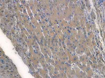 TBK1 Recombinant Rabbit mAb - BF3065 at 1/100 staining human hepatocellular carcinoma by IHC-P.