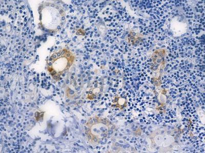 GSK3 beta Recombinant Rabbit mAb - BF3074 at 1/100 staining human thyroid carcinoma by IHC-P.