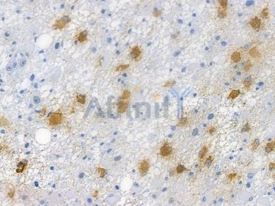 GSK3 beta Recombinant Rabbit mAb - BF3074 at 1/100 staining human astrocytoma by IHC-P.