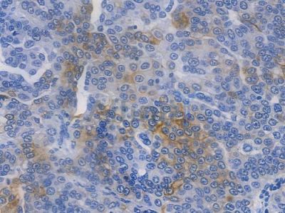 GSK3 beta Recombinant Rabbit mAb - BF3074 at 1/100 staining human ovarian carcinoma by IHC-P.