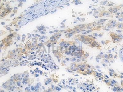 EGFR Recombinant Rabbit mAb - BF3085 at 1/100 staining human lung squamous cell carcinoma by IHC-P.