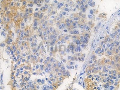 EGFR Recombinant Rabbit mAb - BF3085 at 1/100 staining human lung squamous cell carcinoma by IHC-P.