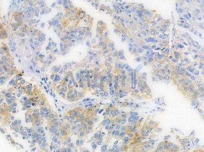 EGFR Recombinant Rabbit mAb - BF3085 at 1/100 staining human prostate carcinoma by IHC-P.