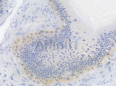 EGFR Recombinant Rabbit mAb - BF3085 at 1/100 staining human testicular cancer by IHC-P.