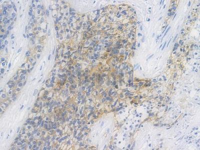 EGFR Recombinant Rabbit mAb - BF3085 at 1/100 staining human breast carcinoma by IHC-P.