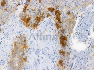 EGFR Recombinant Rabbit mAb - BF3085 at 1/100 staining human esophageal carcinoma by IHC-P.