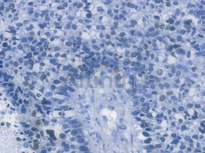 SOX9 Recombinant Rabbit mAb - BF3087 at 1/100 staining human glioblastoma by IHC-P.