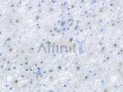 SOX9 Recombinant Rabbit mAb - BF3087 at 1/100 staining human astrocytoma by IHC-P.