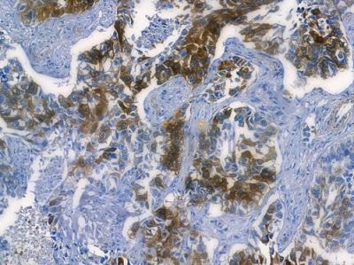 Caspase 9 Recombinant Rabbit mAb - BF3089 at 1/100 staining human lung squamous cell carcinoma by IHC-P.