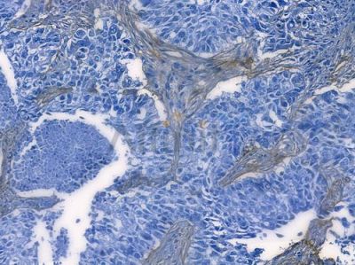 Collagen IV Recombinant Rabbit mAb - BF3100 at 1/100 staining human lung squamous cell carcinoma by IHC-P.