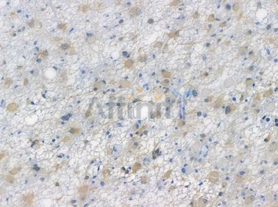 LC3A Recombinant Rabbit mAb - BF3109 at 1/100 staining human astrocytoma by IHC-P.