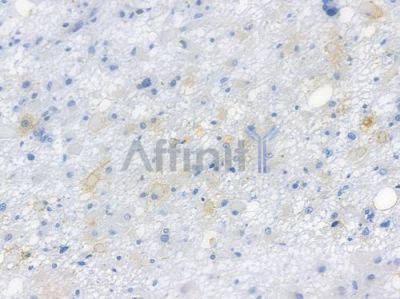 BDNF Recombinant Rabbit mAb - BF3121 at 1/100 staining human astrocytoma by IHC-P.