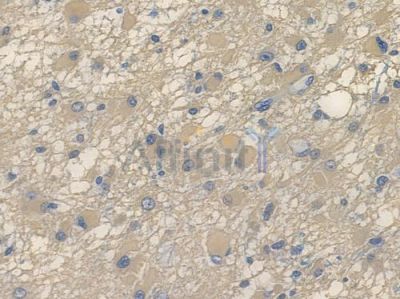 GFAP Recombinant Rabbit mAb - BF3124 at 1/100 staining human astrocytoma by IHC-P.