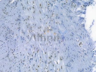 Histone H2A.X Recombinant Rabbit mAb - BF3131 at 1/100 staining human colon carcinoma by IHC-P.