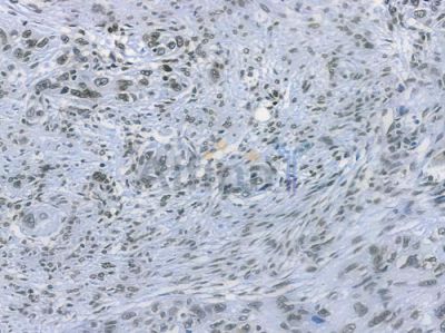 Histone H2A.X Recombinant Rabbit mAb - BF3131 at 1/100 staining human tongue carcinoma by IHC-P.
