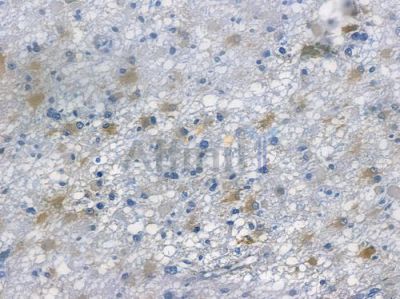 CaMKII alpha Recombinant Rabbit mAb - BF3139 at 1/100 staining human astrocytoma by IHC-P.