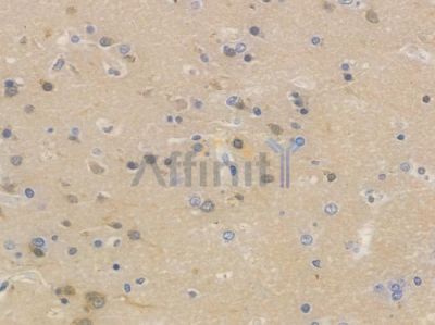 PKA alpha/beta/gamma CAT Recombinant Rabbit mAb - BF3143 at 1/100 staining human glioblastoma by IHC-P.