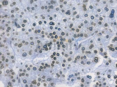 Lamin B1 Recombinant Rabbit mAb - BF3146 at 1/100 staining human hepatocellular carcinoma by IHC-P.