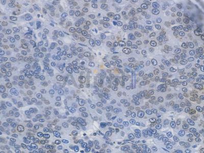 Lamin B1 Recombinant Rabbit mAb - BF3146 at 1/100 staining human ovarian carcinoma by IHC-P.