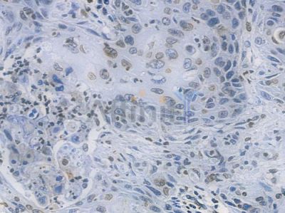 Lamin B1 Recombinant Rabbit mAb - BF3146 at 1/100 staining human esophageal carcinoma by IHC-P.