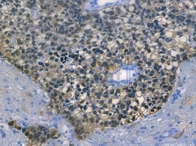 HSP70 Recombinant Rabbit mAb - BF3155 at 1/100 staining human glioblastoma by IHC-P.