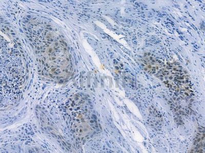 HSP70 Recombinant Rabbit mAb - BF3155 at 1/100 staining human esophageal carcinoma by IHC-P.