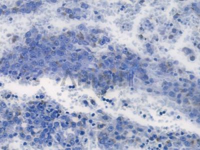 Hexokinase II Recombinant Rabbit mAb - BF3161 at 1/100 staining human melanoma by IHC-P.