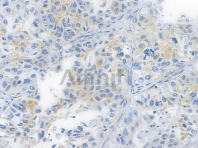 ATF6 Recombinant Rabbit mAb - BF3167 at 1/100 staining human lung squamous cell carcinoma by IHC-P.