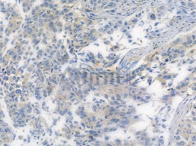 IRS1 Recombinant Rabbit mAb - BF3168 at 1/100 staining human lung squamous cell carcinoma by IHC-P.