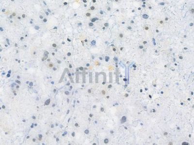 PARP Recombinant Rabbit mAb - BF3170 at 1/100 staining human astrocytoma by IHC-P.