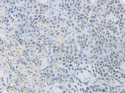 PARP Recombinant Rabbit mAb - BF3170 at 1/100 staining human non-Hodgkin lymphoma by IHC-P.