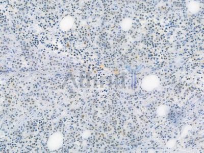PARP Recombinant Rabbit mAb - BF3170 at 1/100 staining human Hodgkin lymphoma by IHC-P.