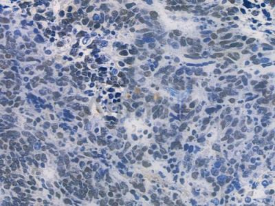 PARP Recombinant Rabbit mAb - BF3170 at 1/100 staining human small cell lung carcinoma by IHC-P.